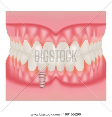 Human Jaw Model With Teeth And Implant. Installation Of Dental Implants Isolated On A White Background. Vector Illustration. Stomatology. Teeth And Tooth Concept Of Dental