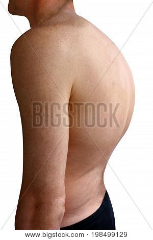 scoliosis thin man on his back no shirt. curvature of the spine visible