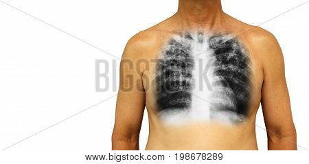 Pulmonary tuberculosis . Human chest with x-ray show interstitial infiltrate both lung due to infection . Isolated background . Blank area at Left side .