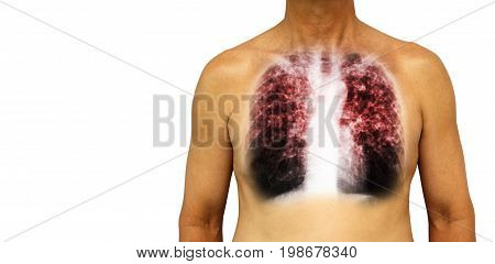 Pulmonary tuberculosis . Human chest with x-ray show interstitial infiltrate both lung due to infection . Isolated background . Blank area at Left side .