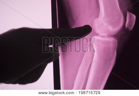 Knee Joint Xray Test Scan