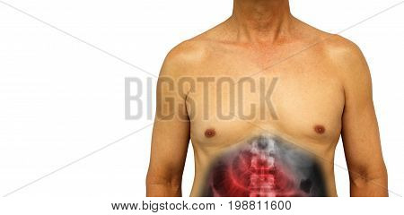 Colon cancer and Small intestine obstruction . Human abdomen with x-ray show small bowel dilated due to obstructed . Isolated background . Blank area at left side .