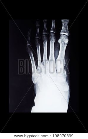 Fluorography of foot with deformation in black frame