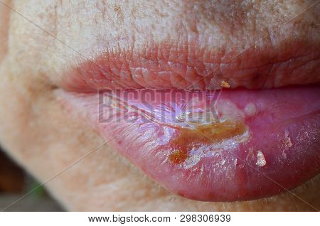 Herpes Labialis Or Commonly Known As Cold Sores, Type Of Infection By The Herpes Simplex Virus That 