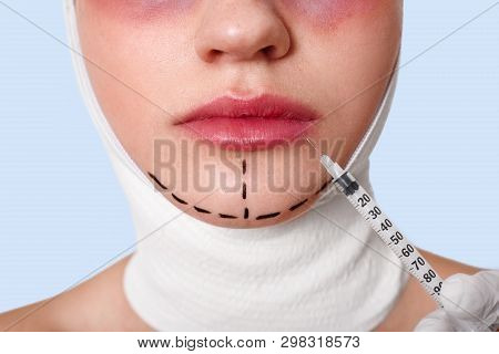 Half Face Portrait Of Young Woman With Arrows On Chin Against Blue Wall. Woman Recived Injection To 