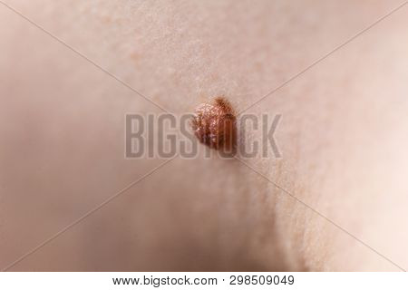 Unrecognizable Person Having Dark Fibroma, Dermatology Problem On Skin. Close Up Of Papilloma Dermat