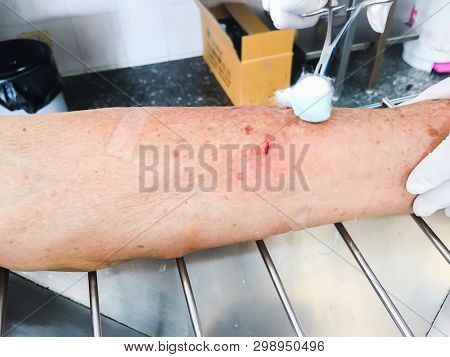 Clean Dressing Abrasion Wound From Dog’s Bite At Arm Of Patient, Medical Emergency Concept