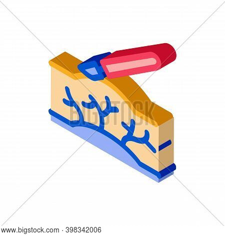 Surgery Treatment Varicose Veins Color Icon Vector. Isometric Surgery Treatment Varicose Veins Sign.