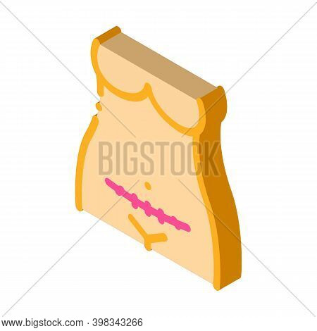 Cesarean Section Color Icon Vector. Isometric Cesarean Section Sign. Color Isolated Symbol Illustrat