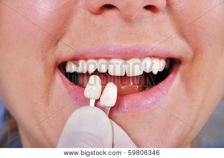 Shade Determination Tooth