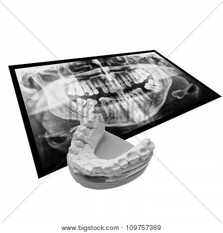 Black And White Xray Of Teeth With Positive Teeth Cast