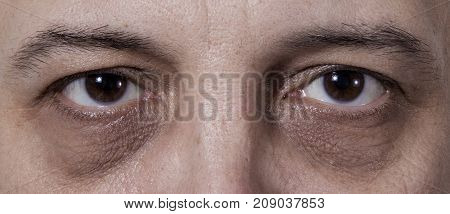 Adult's man eyes with very dark rings
