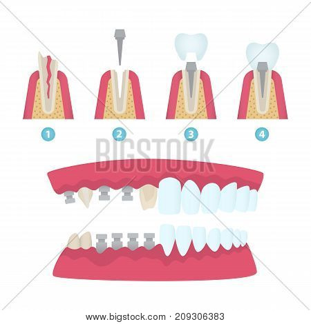 Set of dental crowns and implantation prosthodontics elements and tools. Vector flat illustration.