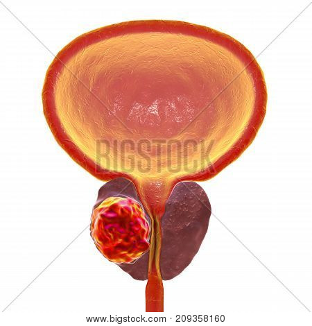 Prostate cancer, 3D illustration showing presence of tumor inside prostate gland which compresses urethra