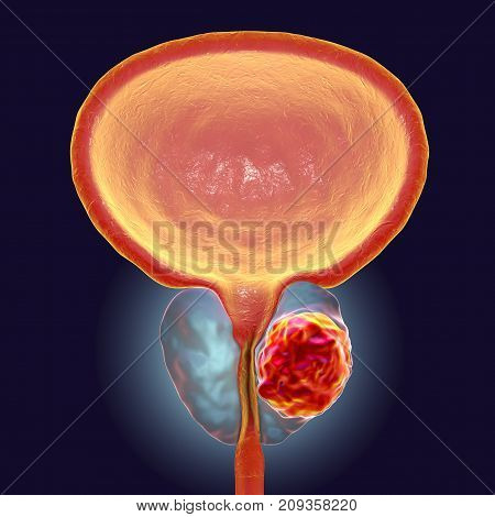 Prostate cancer, 3D illustration showing presence of tumor inside prostate gland which compresses urethra