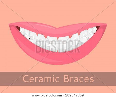 Dental braces, smiling lips in cartoon style isolated. Smile with braces, illustration on the topic of stomatology, orthodontics, teeth alignment bite correction, vector illustration for your projects