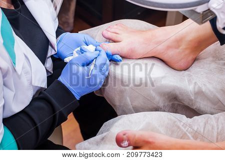 Podology Treatment. Podiatrist Treating Toenail Fungus. Doctor Removes Calluses, Corns And Treats In
