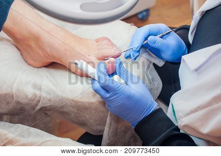 Podology Treatment. Podiatrist Treating Toenail Fungus. Doctor Removes Calluses, Corns And Treats In