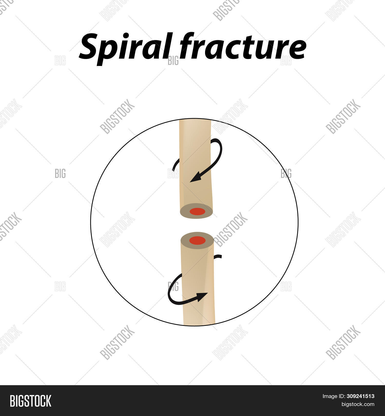Spiral Bone Fracture. Image & Photo (Free Trial) Bigstock