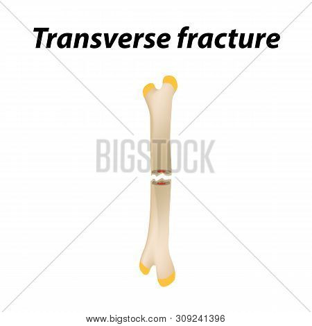 Transverse Bone Fracture. Infographics. Illustration On A Lined Background.