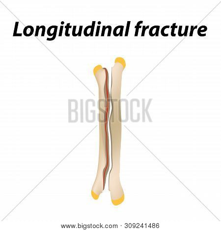 Longitudinal Bone Fracture. Infographics. Illustration On A Lined Background.