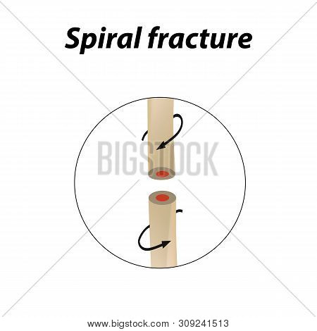 Spiral Bone Fracture. Infographics. Illustration On A Lined Background.