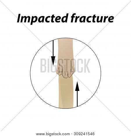Impacted Fracture Bone. Infographics. Illustration On A Lined Background.
