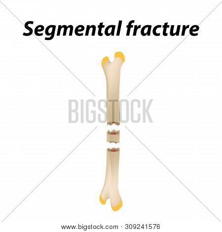 Segmental Fracture Bone. Infographics. Illustration On A Lined Background.