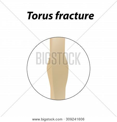 Torus Fracture Bone. Infographics. Illustration On A Lined Background.