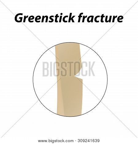 Greenstick Fracture Bone. Infographics. Illustration On A Lined Background.