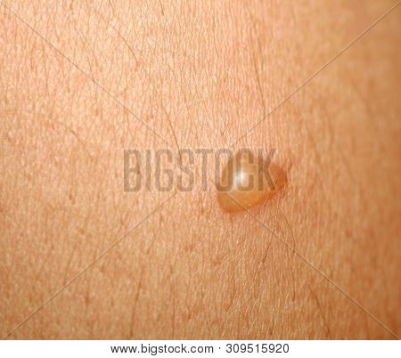 Burn On The Skin. Blister On The Skin