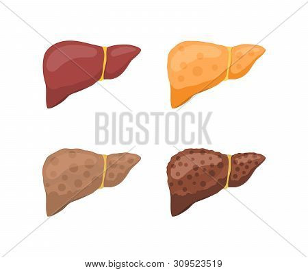 Stages Of Human Liver Damage. Healthy, Fatty, With Fibrosis And With Cirrhosis. Vector Illustration 