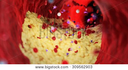 3d rendered medically accurate illustration of a capped plaque in a human artery