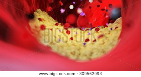 3d rendered medically accurate illustration of a capped plaque in a human artery