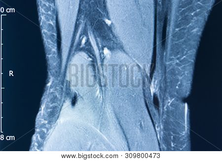 Knee Injury Mri Mcl Tear