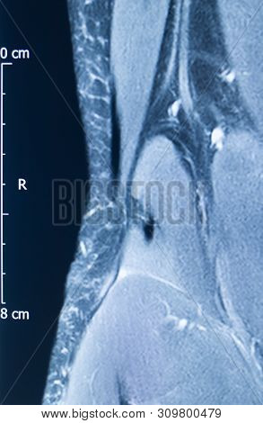 Knee Injury Mri Mcl Tear