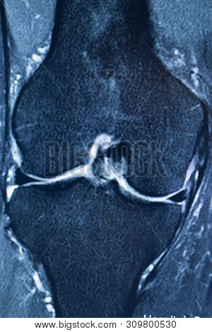 Knee Injury Mri Mcl Tear