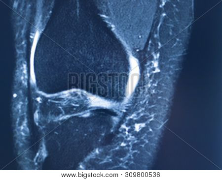 Knee Injury Mri Mcl Tear