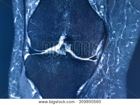 Knee Injury Mri Mcl Tear