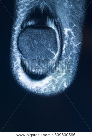 Knee Injury Mri Mcl Tear