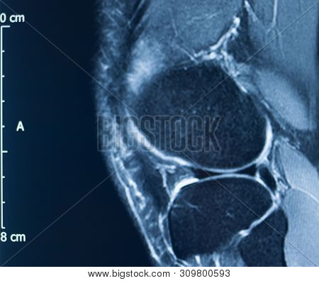 Knee Injury Mri Mcl Tear