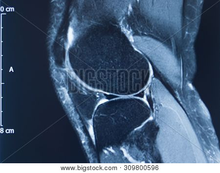 Knee Injury Mri Mcl Tear