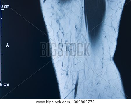 Knee Injury Mri Mcl Tear