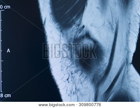 Knee Injury Mri Mcl Tear