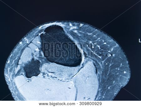 Knee Injury Mri Mcl Tear