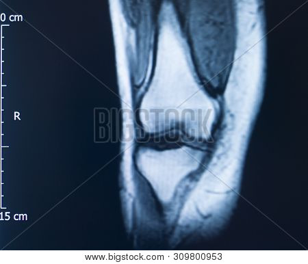 Knee Injury Mri Mcl Tear
