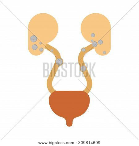 Stones In Kidneys. Nephrolithiasis Kidney Stones Disease. Medical Vector Illustration