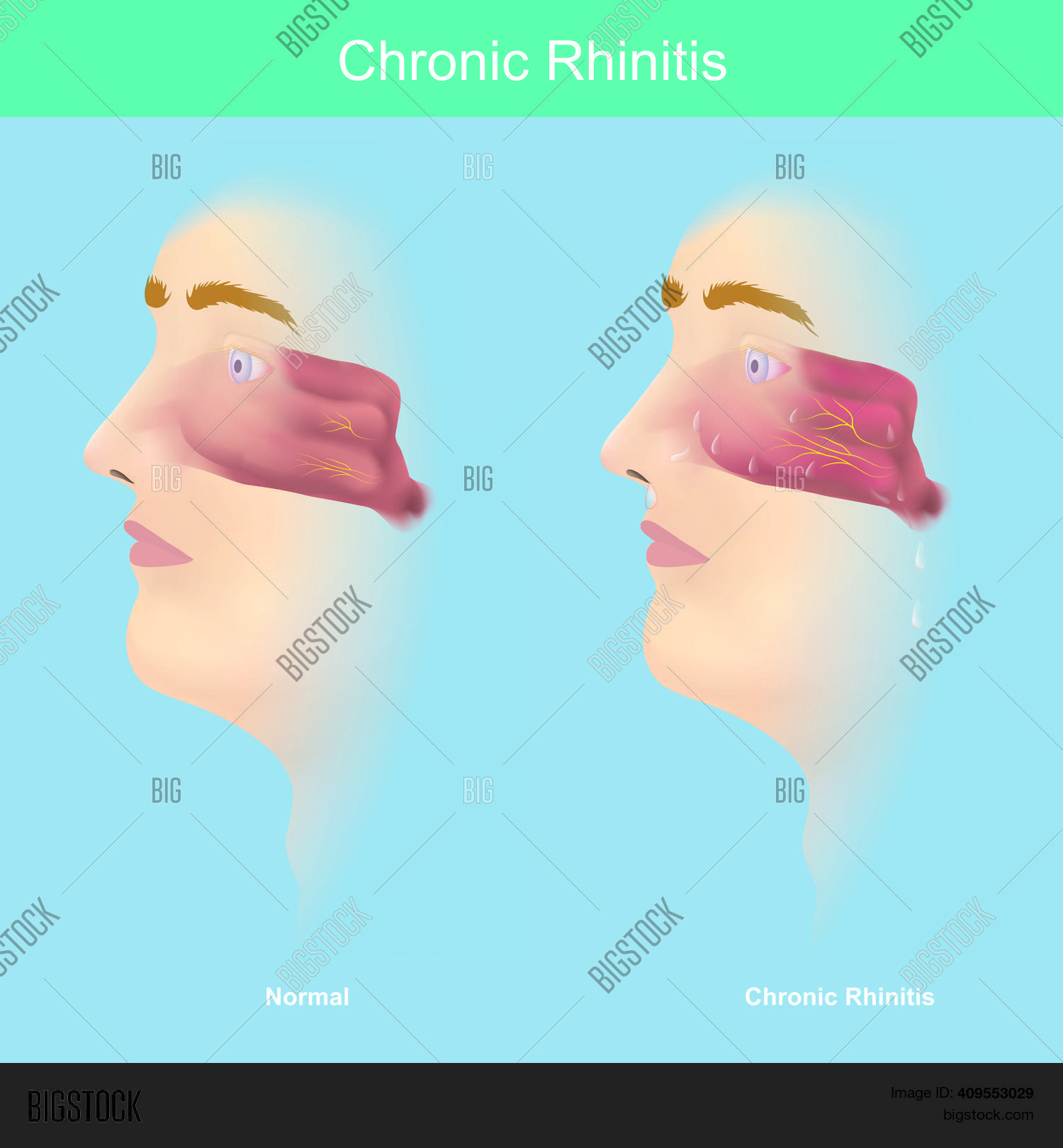 Chronic Rhinitis Imag Chronic Rhinitis. Vector & Photo (Free Trial) | Bigstock