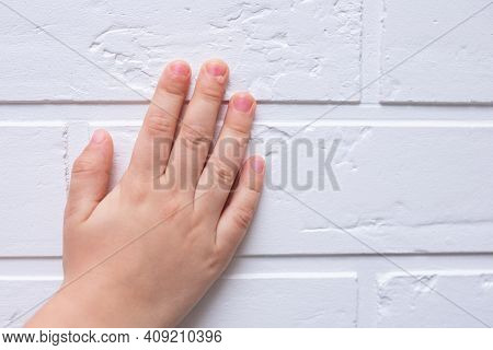 Common Wart Verruca Vulgaris A Flat Wart On The Hand Of Children And Adults. They Are Caused By A Ty