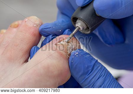 The Podiatrist Cuts Off The Damaged Part Of The Diseased Nail. Toenail Fungus. Medical Pedicure In T